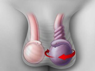 testicular torsion as a cause of pain